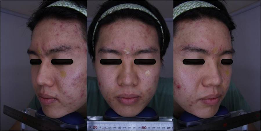 research_medical_imaging_acne_2.jpg