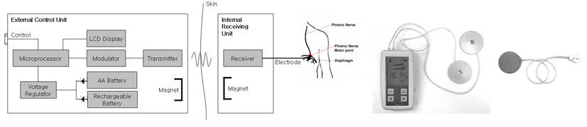 Diaphragmatic Breathing Pacemaker